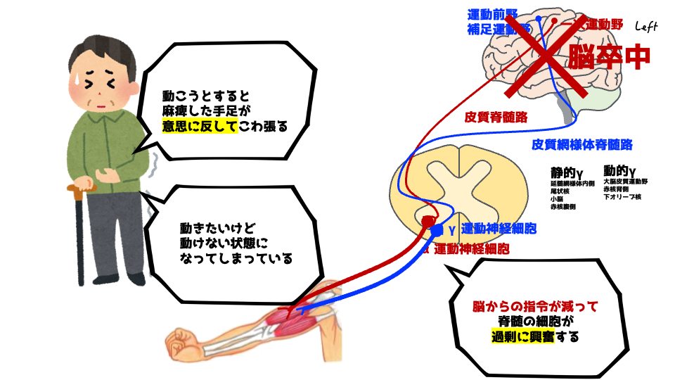 痙縮の画像