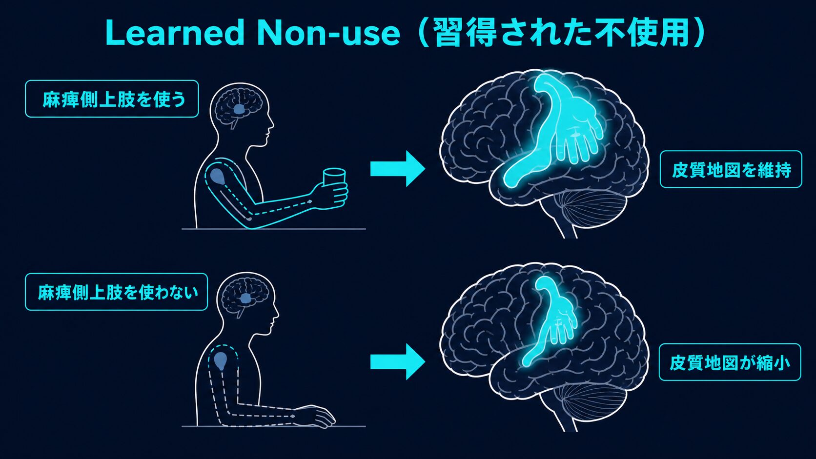 皮質脊髄路の損傷と運動障害：内包後脚・SAFE score