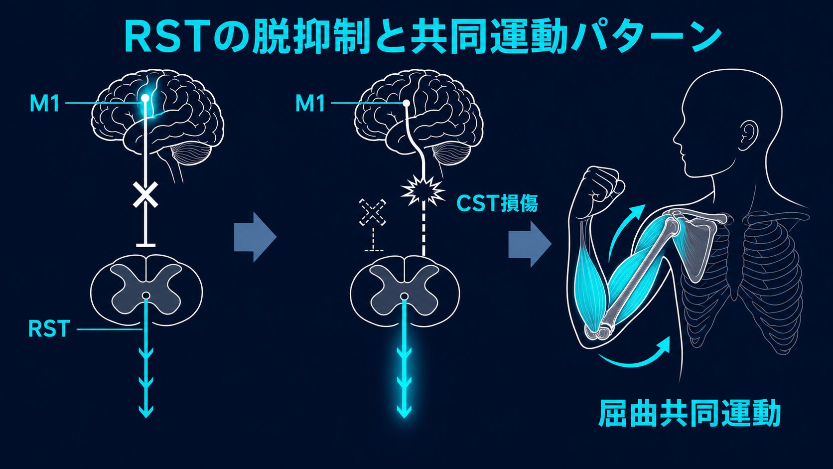 制限因子の見極めフロー：SAFE・MEP・Brunnstromから介入方針へ