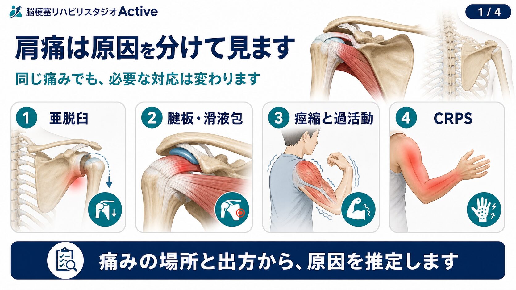 脳卒中後の肩痛の図解