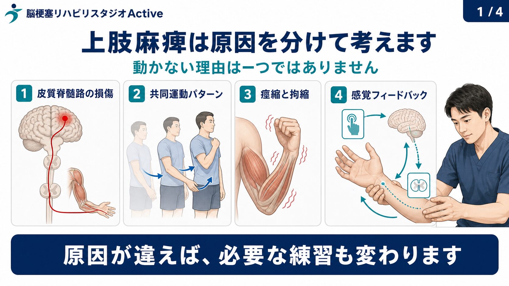 脳卒中後の上肢麻痺の図解