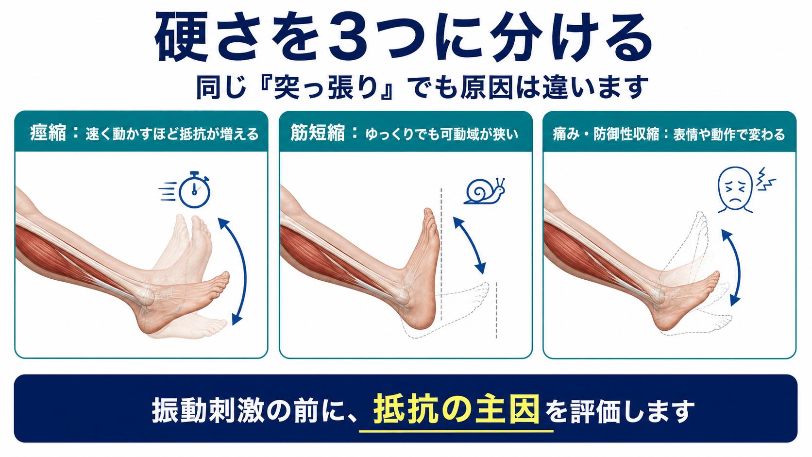 脳卒中後の硬さを痙縮、筋短縮、痛みと防御性収縮に分けて評価する図解
