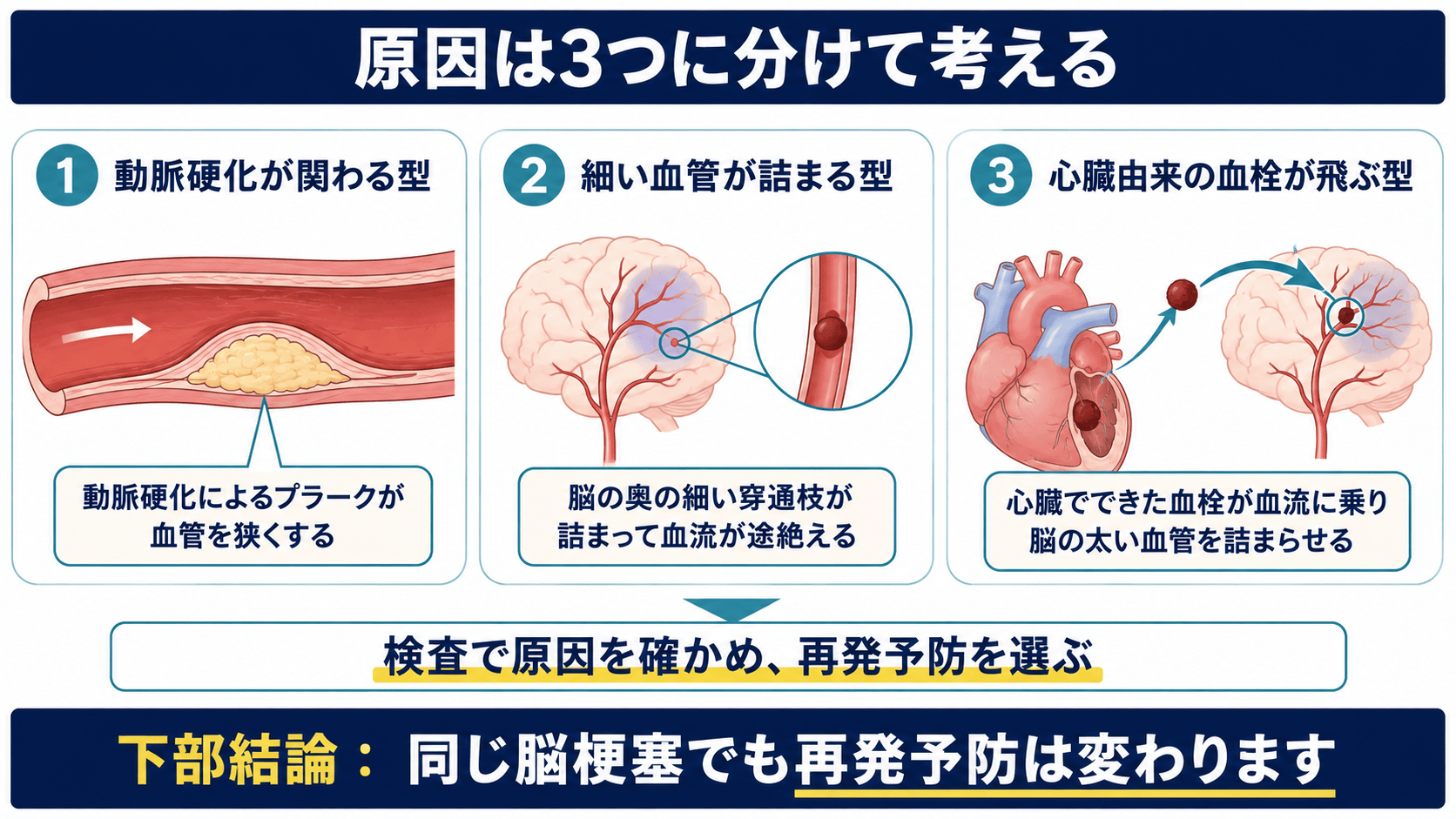 脳梗塞の主な原因を動脈硬化、細い血管、心臓由来の血栓に分ける図解