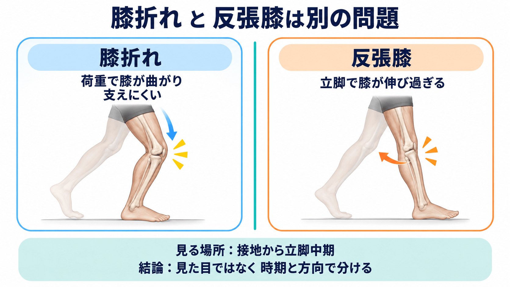 脳卒中後の膝折れと反張膝を立脚期の見え方で区別する図解